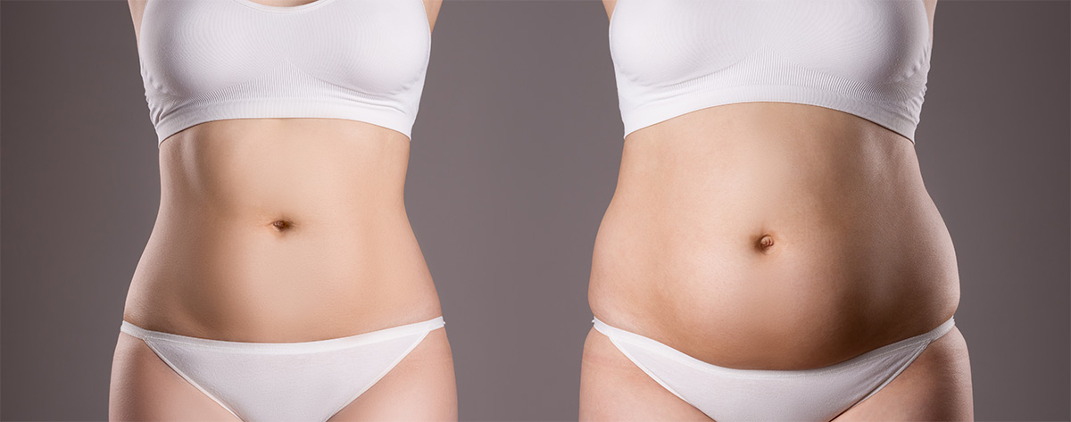 Behandlungsablauf einer Fettabsaugung – vorher und nachher