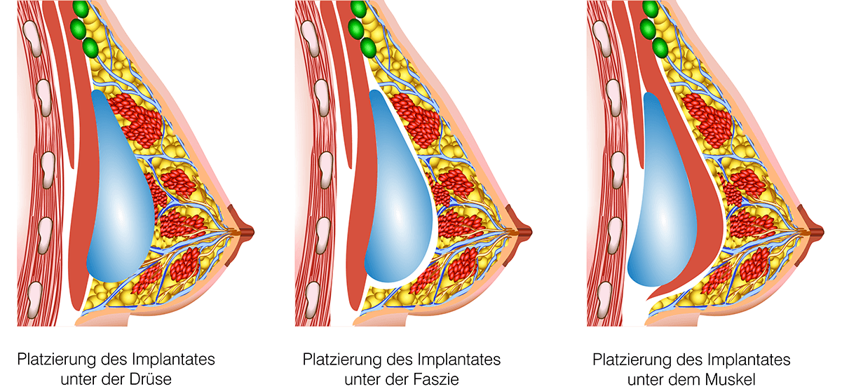 Platzierung der Implantate bei einer Brustvergrößerung