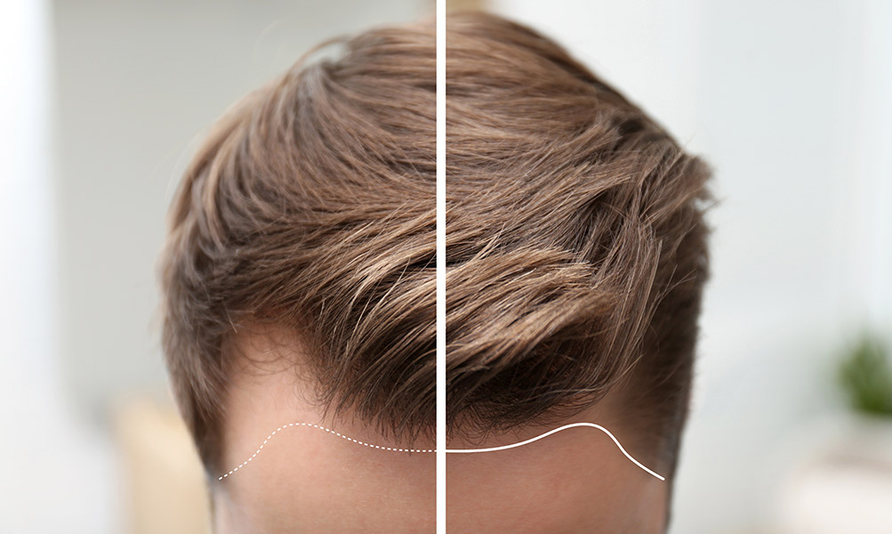 Behandlung Haarausfall – Vorher-Nachher-Bilder
