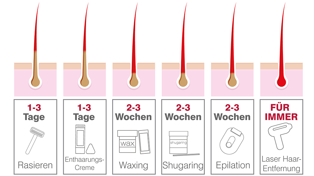 Haarentfernung (SHR oder IPL): Welche ist die beste Methode?