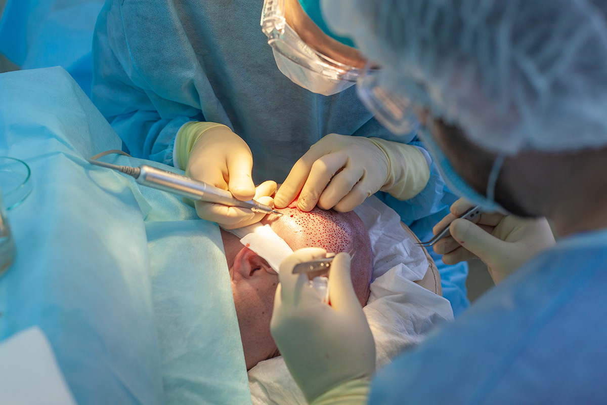 Haartransplantation: die FUE Methode