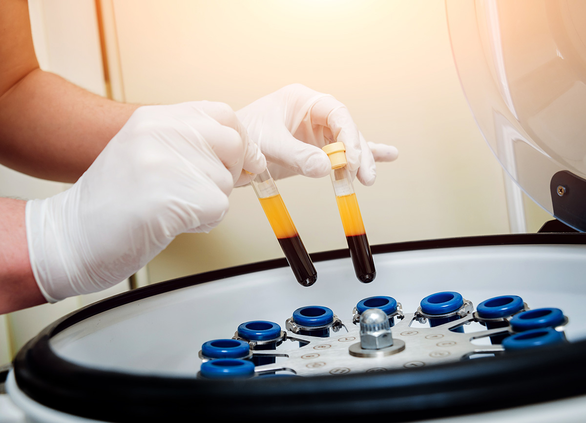 PRP-Stammzellentherapie