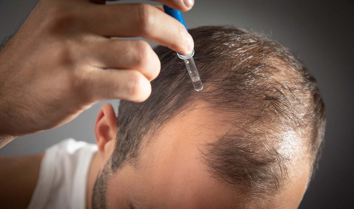 Minoxidil: das „Wundermittel“ gegen Haarausfall?