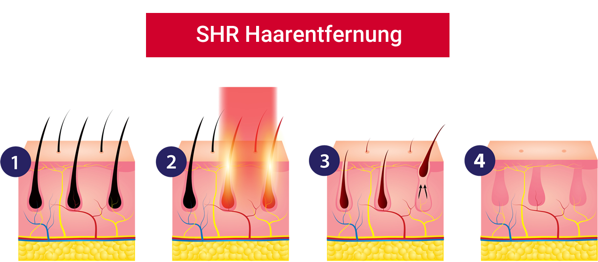 SHR Haarentfernung