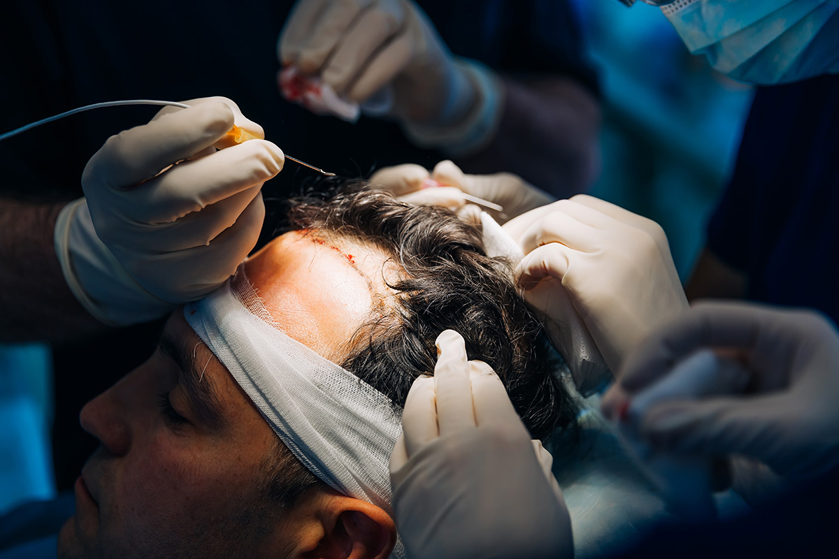 Haartransplantation von Geheimratsecken im Ausland