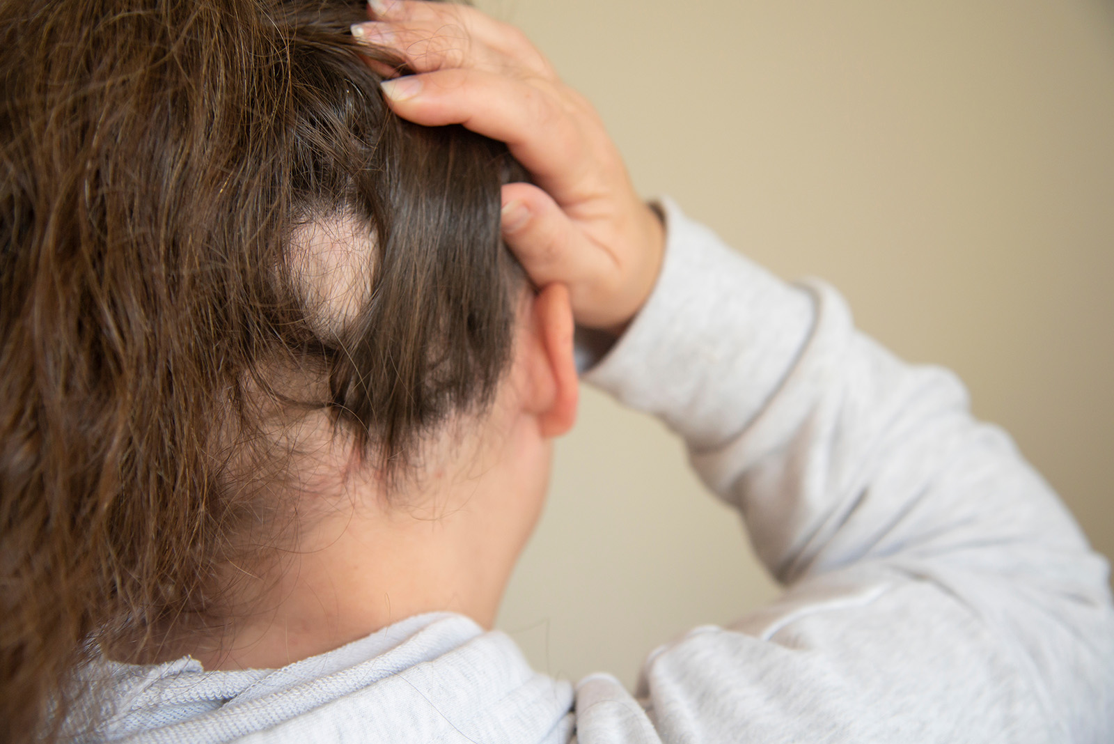 Was hilft bei kreisrundem Haarausfall? Behandlungsmethoden in unserer Haarklinik in Frankfurt und München