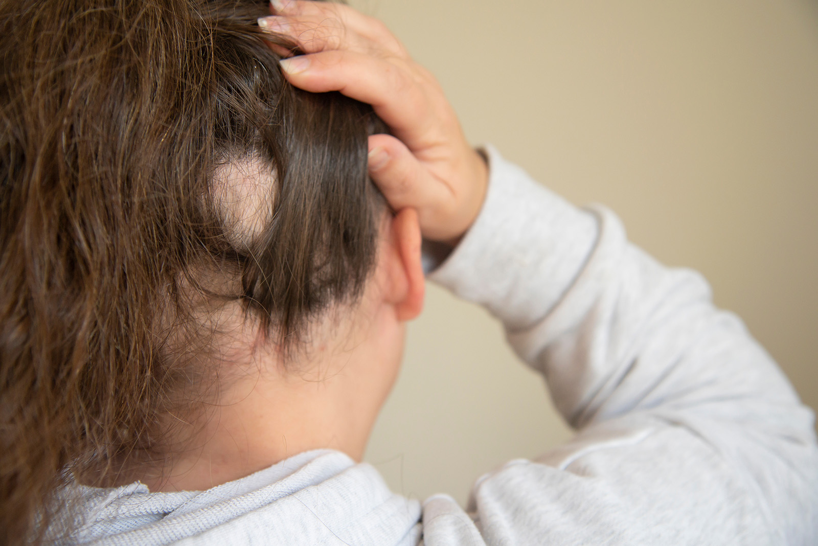 Wie kommt das PRP an die Haarwurzel?