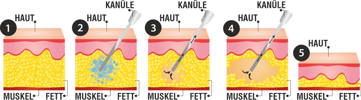 Beschreibung und Skizzen einer Fettabsaugung