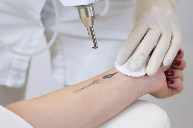 Kosten einer Tattooentfernung