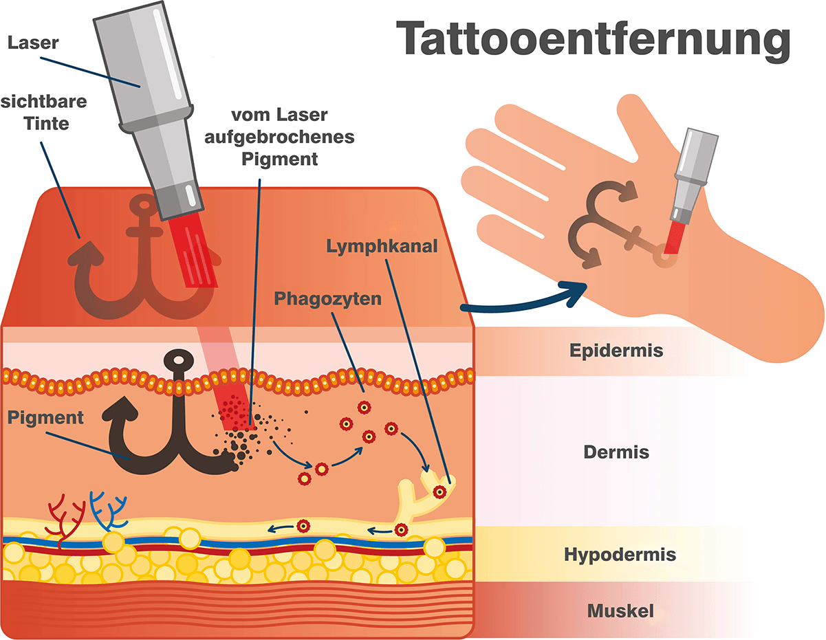Ablauf einer Tattooentfernung im [AQ] Frankfurt